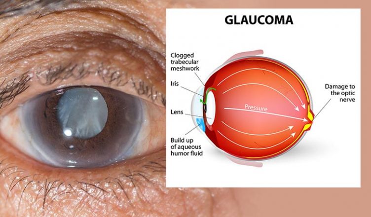 Glaucoma Medicina Ocular 9843